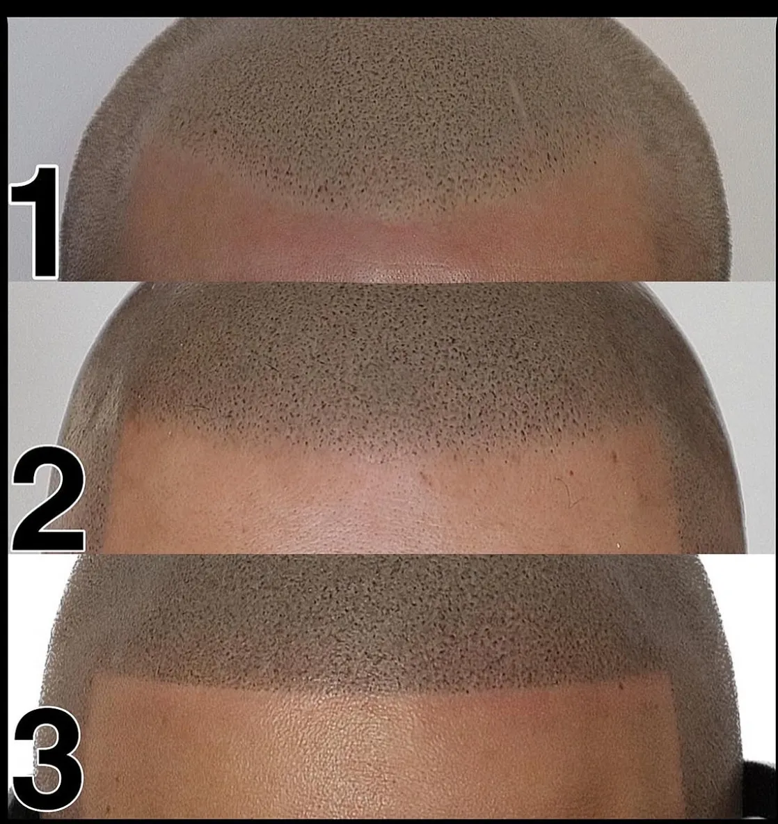 SMP before and after result 1