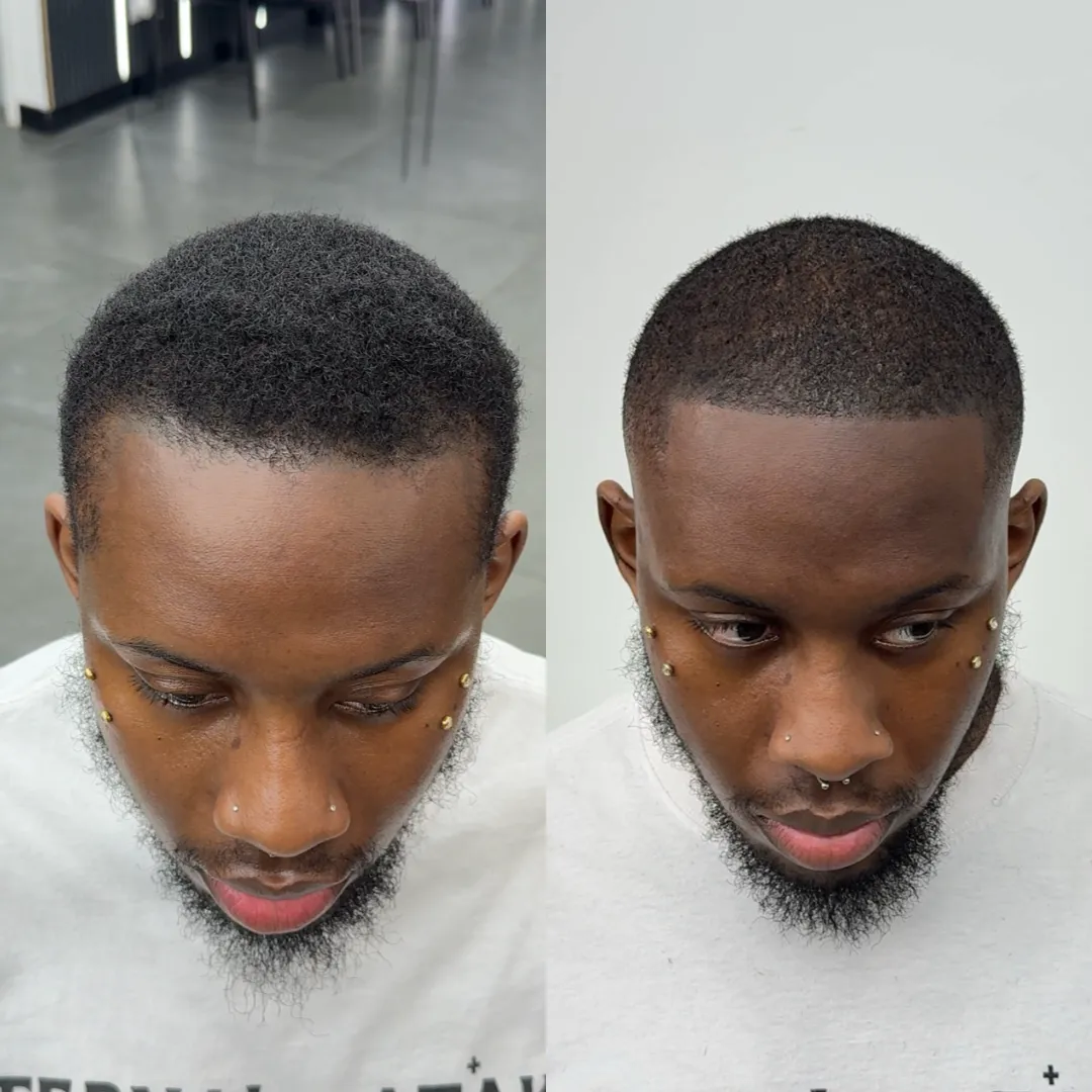 SMP before and after result 2