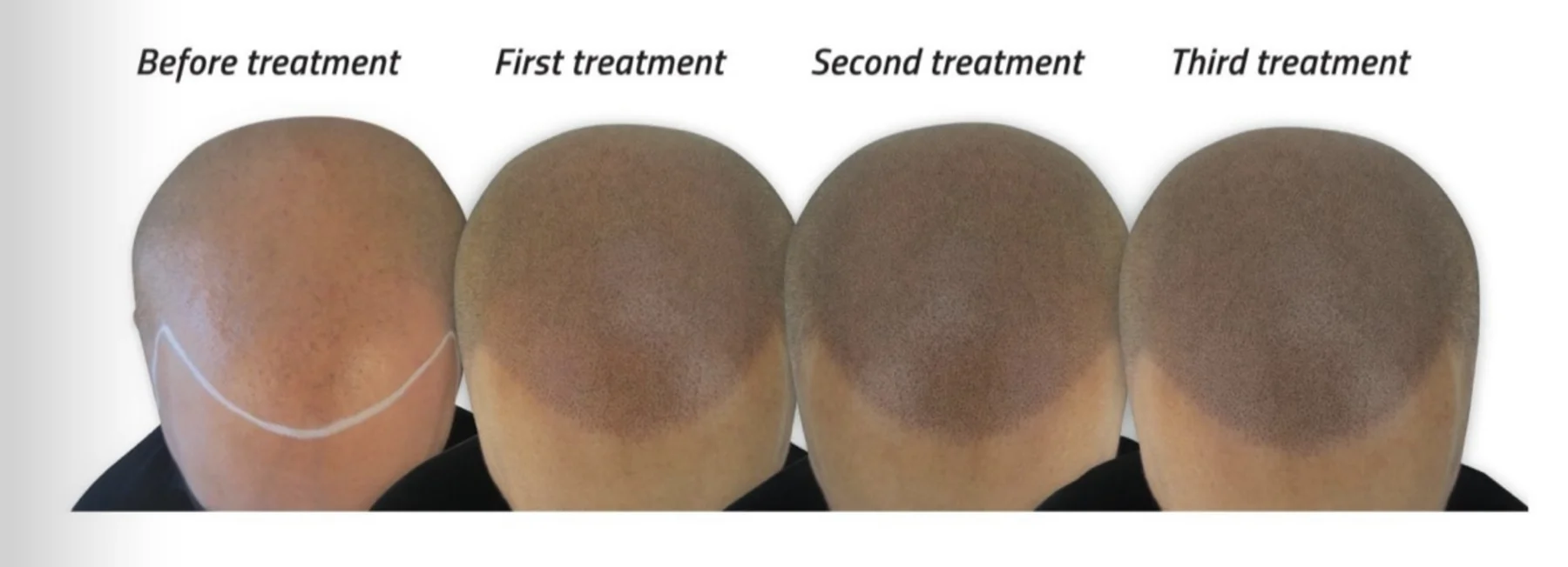 Scalp micropigmentation progress: before, first, second and third treatment